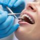 Painless Wisdom Teeth Extraction: What to Expect and How to Prepare