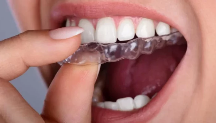 What is Unique About Invisalign?