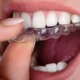 What is Unique About Invisalign?