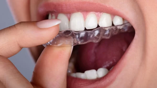 What is Unique About Invisalign?